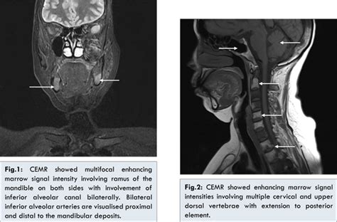 Metastatic Breast Carcinoma Associated with Numb Chin Syndrome
