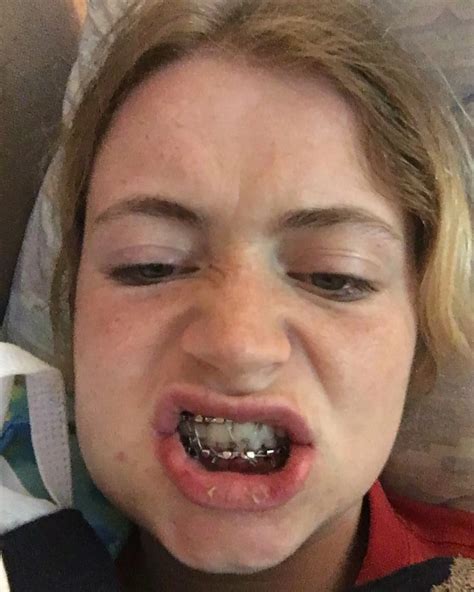 An interview with the girl who had her jaw wired shut - The Face