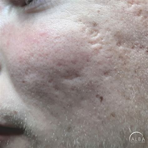 Boxcar Shaped Acne Scar