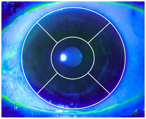 Effect of Strabismus Surgery on Meibomian Glands, Ocular Surface ...