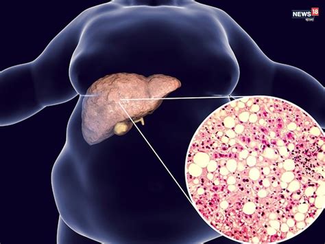 Hepatitis Liver Disease Stages: లివర్‌ను దశలవారీగా డ్యామేజ్ చేసే ...