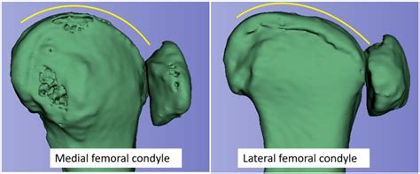 The Trochlear Paradox in Native Knees and Its Potential Impact on Total ...