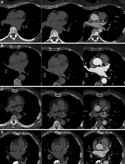 Coronary Artery Calcium Scoring Using Virtual Versus True Noncontrast ...