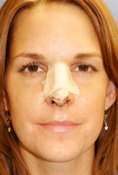 What does the cast look like after rhinoplasty? | Seattle Facial Plastic Surgeon| Dr. Lamperti ...