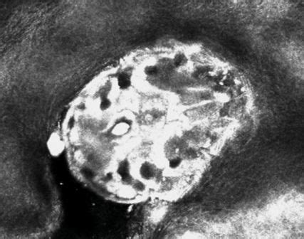 Skabies: vom klinischen Bild bis zu einer neuen Mutation – ein Überbli ...