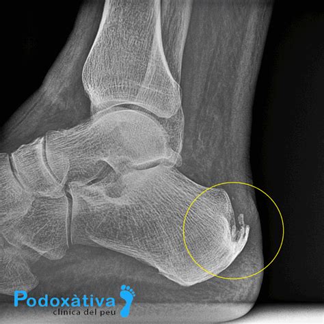 Calcificaciones en el tendón de Aquiles: causas y tratamiento - Podoxàtiva