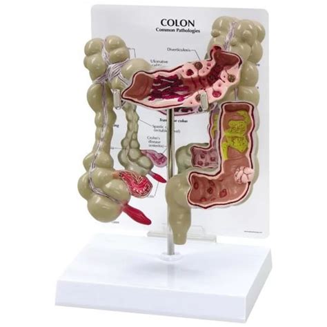 Colon Pathological Model - Human Intestine – HomoSapiens