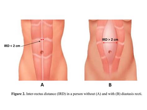 An overview of the management of diastasis of the rectus abdominal muscles. | Published in ...