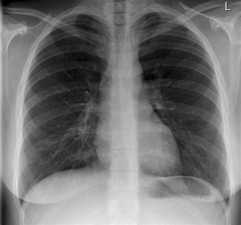 Reading The Chest X-Ray (Chest Radiography): Identifying A Normal Chest ...
