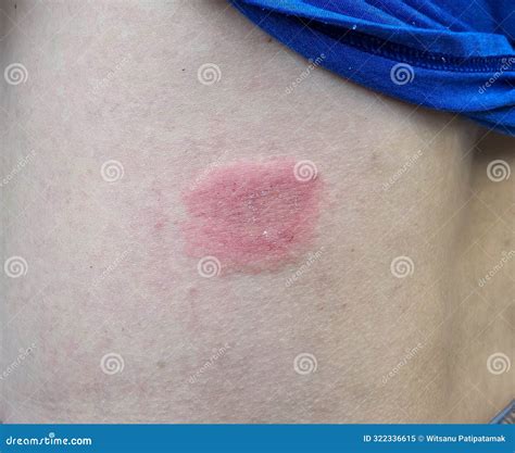 Ringworm Rash On Stomach