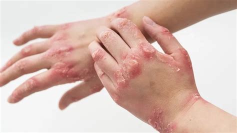 Measles explained - A guide to prevention at home