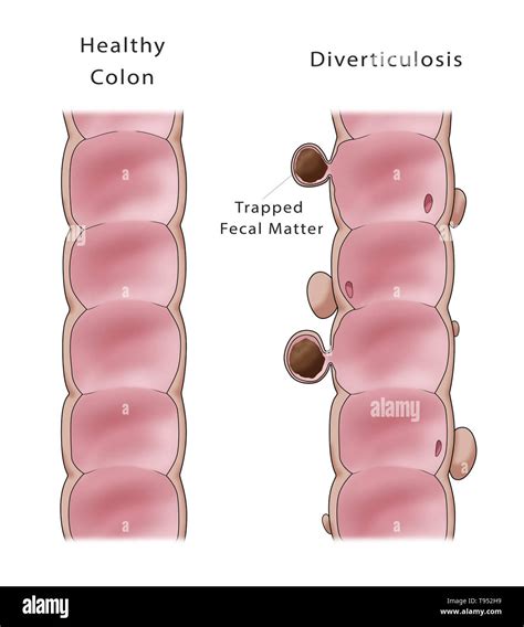 Diverticulosis of colon hi-res stock photography and images - Alamy