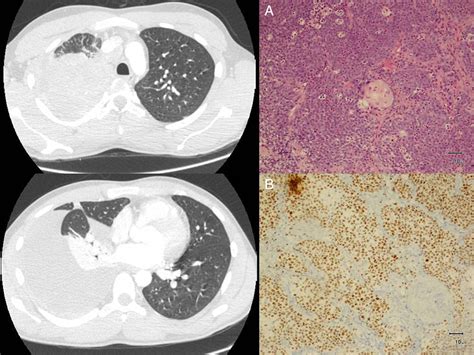 NUT Midline Carcinoma of the Lung, A Rare Form of Lung Cancer | Archivos de Bronconeumología