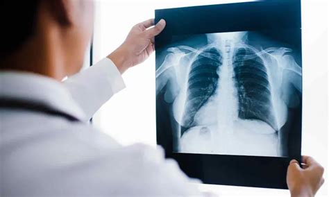Chest radiography effective as pulmonary function tests for COPD ...