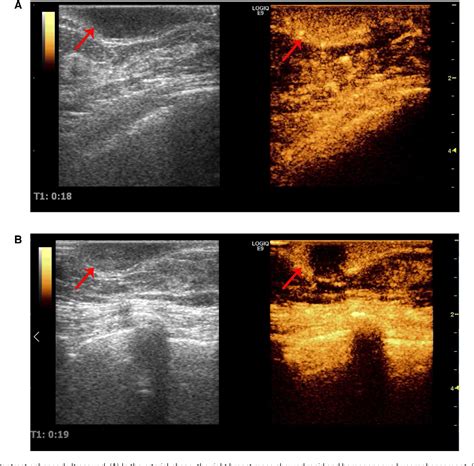 Figure 3 from T-cell lymphoblastic lymphoma/leukaemia involving bilateral breast: a case report ...