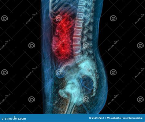 CT Colonography or CT Scan of Colon 3D Rendering Image for Screening Colorectal Cancer. Check Up ...