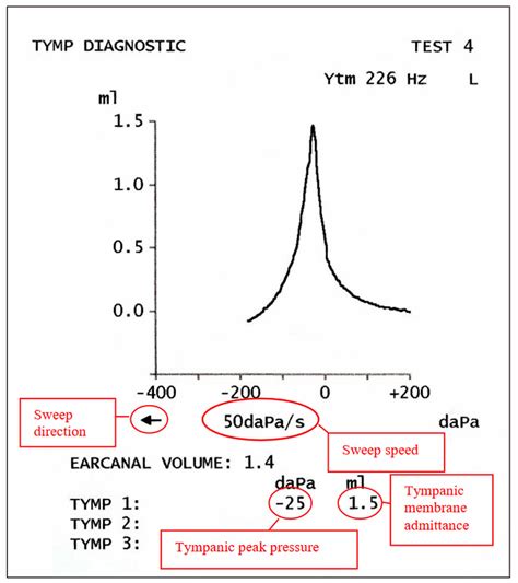 Tympanometry test, tympanometry types & abnormal tympanometry results
