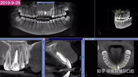 病例报告第6期：门牙摔断再修复，95%人不知道断牙后“黄金30分钟”！ - 知乎