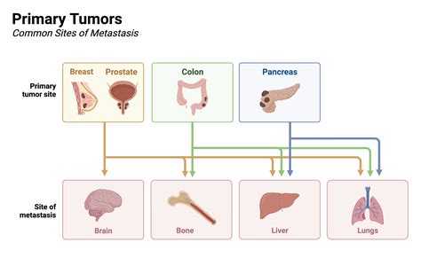Primary Tumors and their Common Sites of Metastasis | BioRender Science Templates