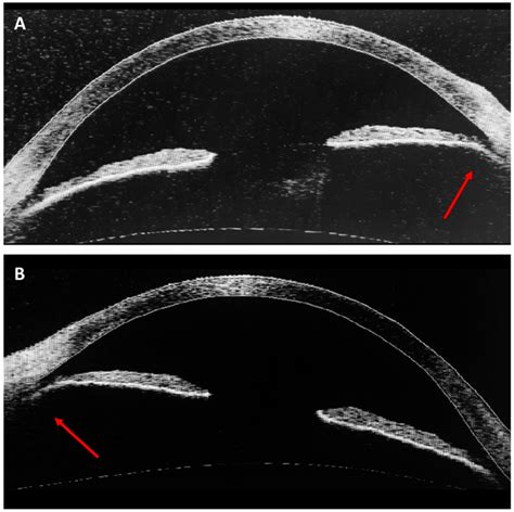 Angle Recession 的图像结果