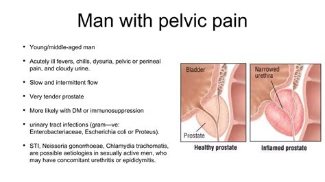 Acute and chronic prostatitis presentation IDF Malaga | PPTX