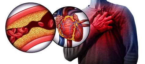 Heart Disease | Types, Symptoms, & Causes : CVG Cares