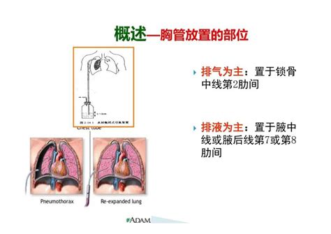 【PPT】胸腔闭式引流管的护理_文库