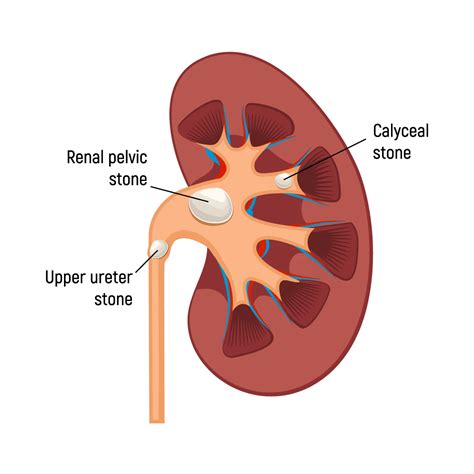 Ureteral Stones: Diagnosis and Treatment | Aurora Health Care