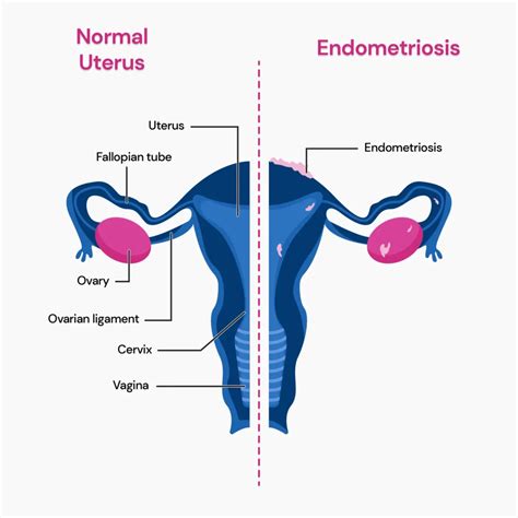 Is Endometriosis Hereditary