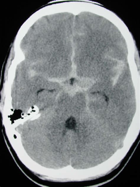 Subarachnoid Hemorrhage Vs Subdural Hematoma