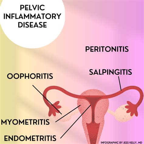 #83: Ascend Your Understanding of Pelvic Inflammatory Disease (PID ...