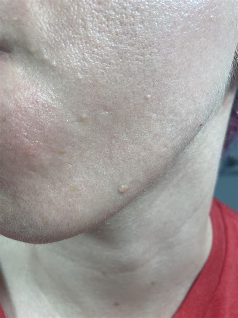 What is this bump on my face? : r/DermatologyQuestions