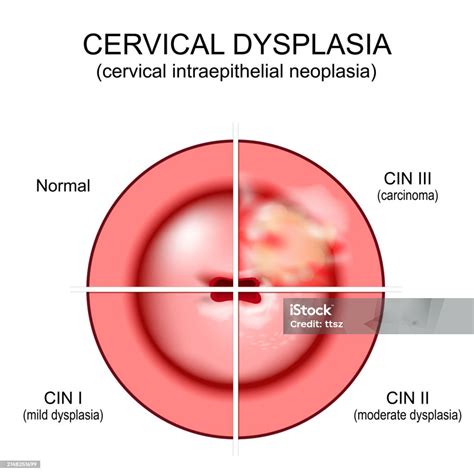 Cervical Dysplasia Closeup Of A Cervix Cervical Cancer Stock ...