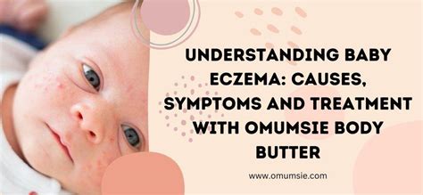 Baby Eczema: Causes, Symptoms, & Treatment – omumsie