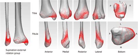 Three-dimensional computed tomography mapping of posterior malleolar fractures