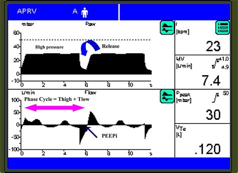 Airway Pressure Release Ventilation in Acute Respiratory Distress Syndrome - Critical Care Clinics