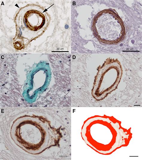 Vascular Collagen Type-IV in Hypertension and Cerebral Small Vessel ...