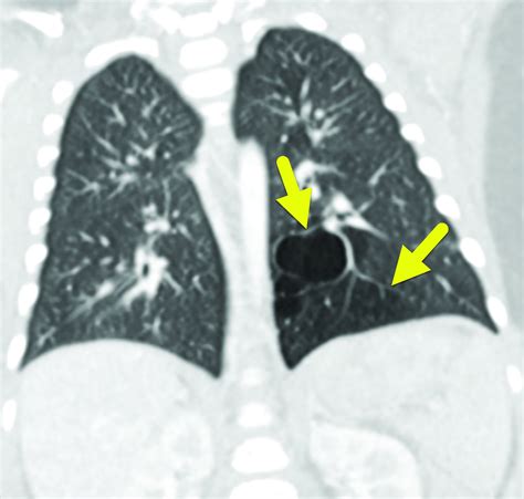 Congenital Pulmonary Airway Malformation | Applied Radiology