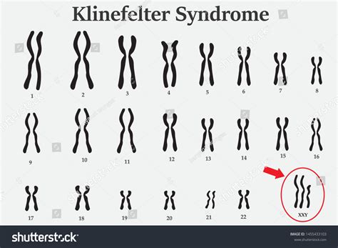 Mosaic Klinefelter Syndrome