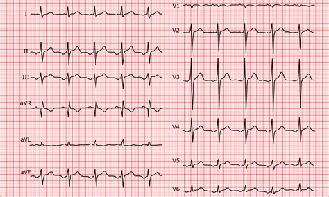 ectopic atrial rhythm 心電図 | 房室結節 心電図 読み方 – UNGM