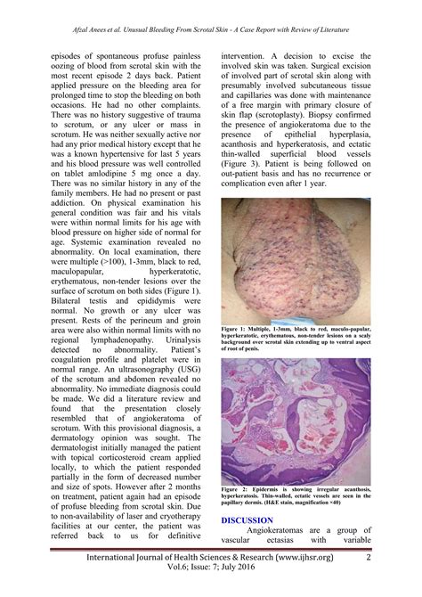 Unusual bleeding from scrotal skin angiokeratoma of scrotum | PDF