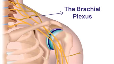 Brachial plexus injuries - Debora Garozzo