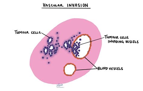 What is vascular invasion? – MyPathologyReport