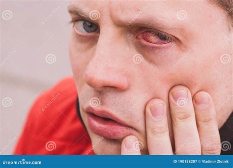 Broken Blood Vessel in Eye. Man with the Subconjunctival Hemorrhage Stock Image - Image of ...