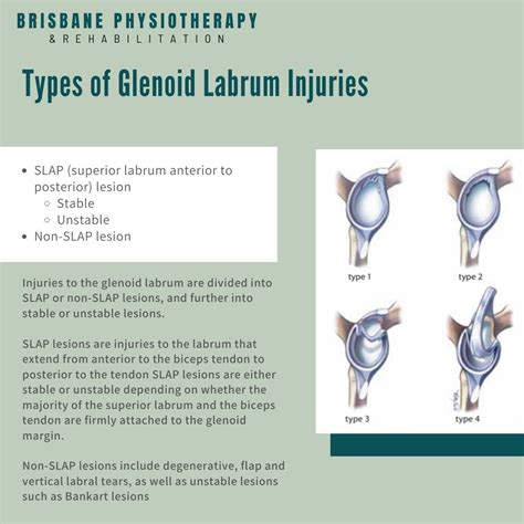 Shoulder Glenoid Labrum Injury - What is it? Symptoms, Treatment ...
