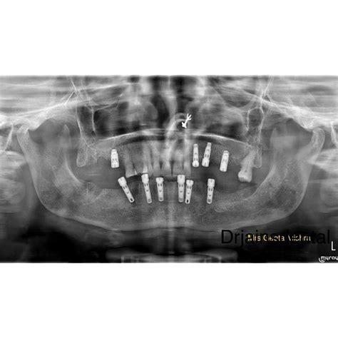 Best Dental implants in Noida| Dr Jains Dental