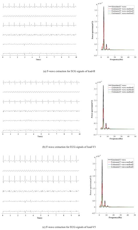 F-Wave Extraction from Single-Lead Electrocardiogram Signals with ...