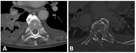 Imaging Characteristics of Diffuse Idiopathic Skeletal Hyperostosis ...
