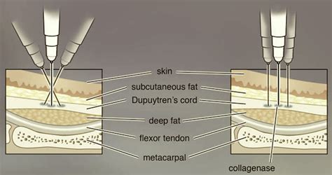 Collagenase Injections For Dupuytren's Contracture