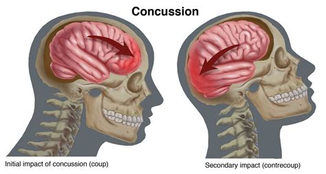 anatomy | Concussions, Physical therapy, Post concussion syndrome